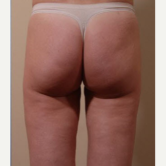 35-44 year old woman treated with Smart Lipo after 3705237