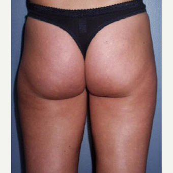 35-44 year old woman treated with Smart Lipo before 3705237