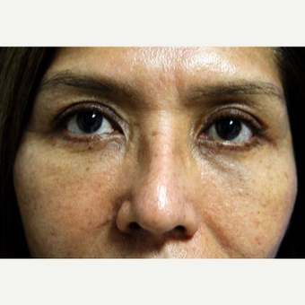 45-54 year old woman treated with Eyelid Surgery after 3093882