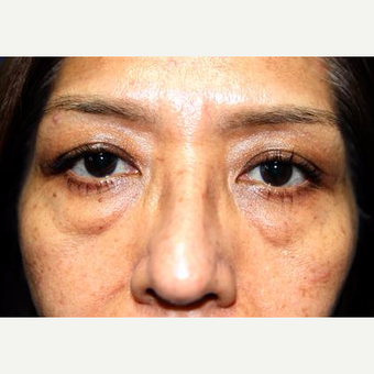 45-54 year old woman treated with Eyelid Surgery before 3093882