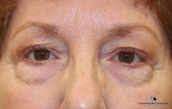 64 year old woman treated with Eyelid Surgery before 3139969