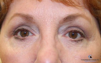 64 year old woman treated with Eyelid Surgery after 3139969