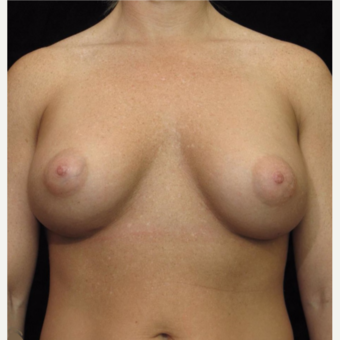 25-34 year old woman treated with Breast Augmentation after 3104767