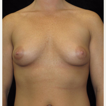 25-34 year old woman treated with Breast Augmentation before 3104767