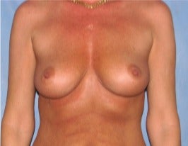 45-54 year old woman treated with Breast Augmentation before 3345153