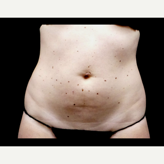 25-34 year old woman treated with truSculpt before 3564719