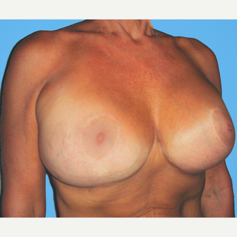 Breast Lift with Implants after 3748852