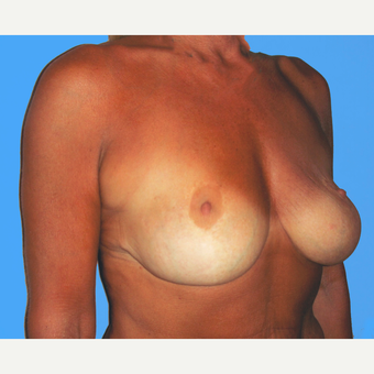 Breast Lift with Implants before 3748852