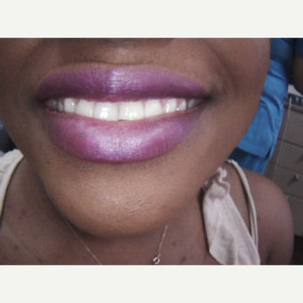 25-34 year old woman treated with Dental Crown after 3656259