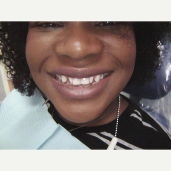 25-34 year old woman treated with Dental Crown before 3656259
