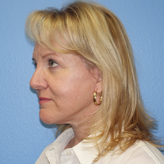 35-44 year old woman treated with Breast Augmentation after 3137470