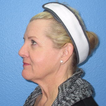 35-44 year old woman treated with Breast Augmentation before 3137470