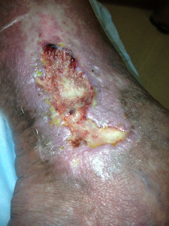 55 year old man with chronic venous stasis ulcer before 997388