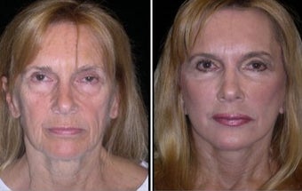65-74 year old woman treated with Quick Lift before 1966094