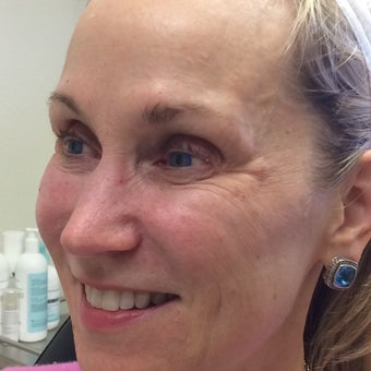 45-54 year old woman treated with Voluma after 1988929