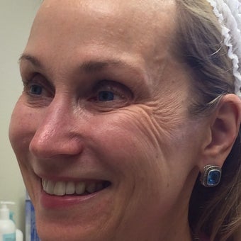 45-54 year old woman treated with Voluma before 1988929