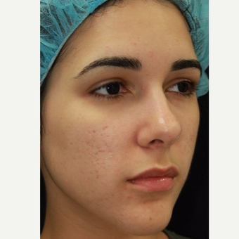 19 year old woman treated with chemical peel and vascular laser for acne scars after 3055237