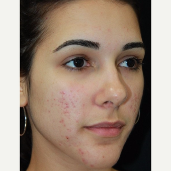 19 year old woman treated with chemical peel and vascular laser for acne scars before 3055237