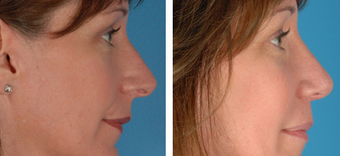 Revision Rhinoplasty before 1208286
