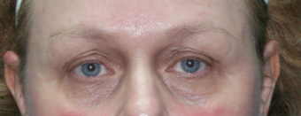 Resurfacing for Under Eye Bags before 1064650