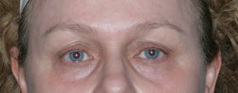 Resurfacing for Under Eye Bags after 1064650