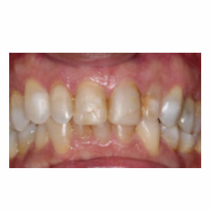 Discolord teeth treated with Dental Crown before 3696628