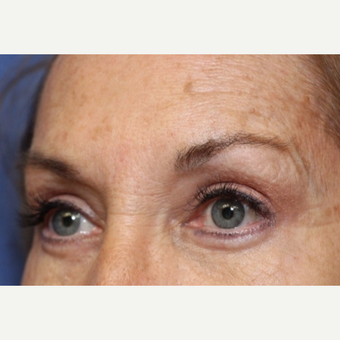 62 year old woman with Eyelid Surgery after 3696949