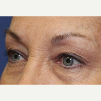 62 year old woman with Eyelid Surgery before 3696949