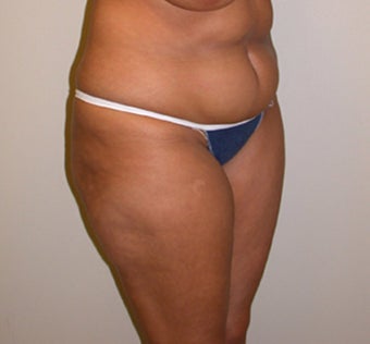 28 year old woman treated with SAFELipo 3110249
