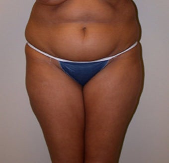 28 year old woman treated with SAFELipo before 3110249