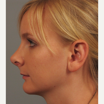 18-24 year old woman treated with Rhinoplasty after 3344162