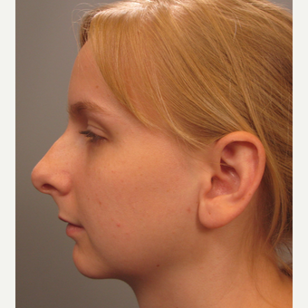 18-24 year old woman treated with Rhinoplasty before 3344162