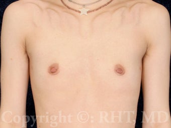23 year-old gender-nonconforming patient requesting keyhole mastectomies 1304432