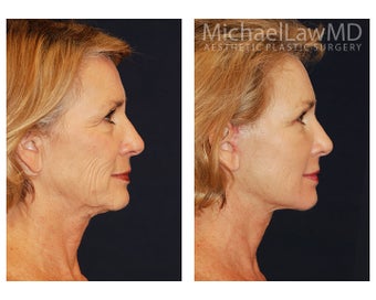 Facial Rejuvenation before 1285311