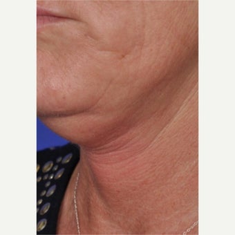 45-54 year old woman treated with ThermiTight before 2461158