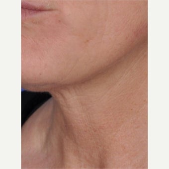 45-54 year old woman treated with ThermiTight after 2461158