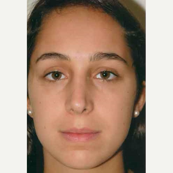 18-24 year old woman treated with Rhinoplasty after 3413810