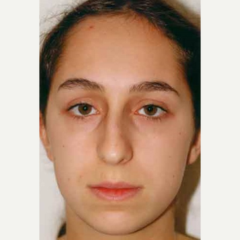 18-24 year old woman treated with Rhinoplasty before 3413810