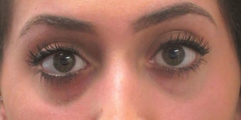 Before and after treatment of lower eyelid hollowing with Restylane before 3422895