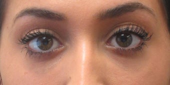 Before and after treatment of lower eyelid hollowing with Restylane after 3422895