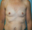 35 year old female patient before 944365
