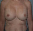 35 year old female patient after 944365