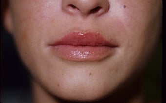 Lip Enlargement with Fillers (JUVEDERM) after 1042908