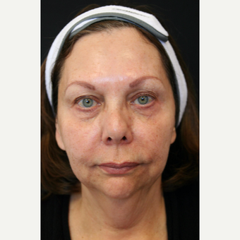 67 year old woman treated with Vertical Vector face & neck lift before 3701694