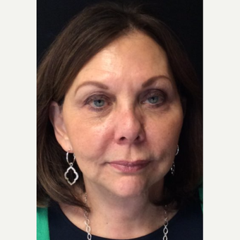 67 year old woman treated with Vertical Vector face & neck lift after 3701694