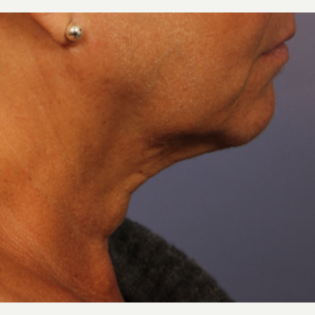 55-64 year old woman treated with Ultherapy after 3698668