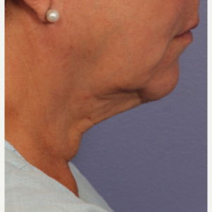 55-64 year old woman treated with Ultherapy before 3698668