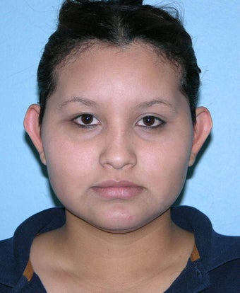 Otoplasty before 1292725