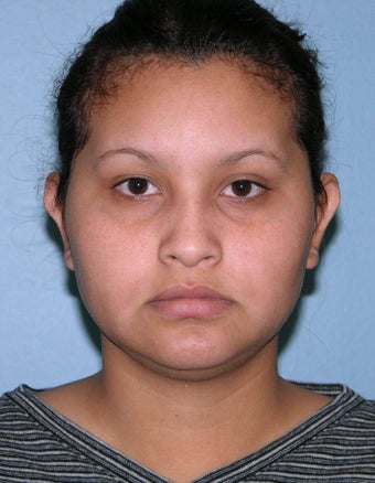 Otoplasty after 1292725
