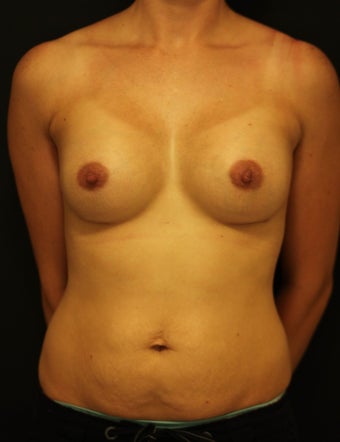 Breast augmentation 1 after 251877